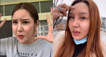 臉上打進400多支玻尿酸!網紅「整形失敗」崩潰:我變畸形了