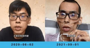 一年瘦成皮包骨!抗癌網紅「敵不過病魔」 奮鬥過程引網淚崩