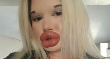 女子「狂打30次」玻尿酸豐唇!沉迷整形追求世界最大嘴唇 醫警告:再整就堵住鼻孔