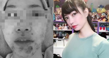 女神實況主「sandy」公開十年「爛痘」黑歷史「吃藥後頭髮大把大把的掉」! 網友淚推:太勵志