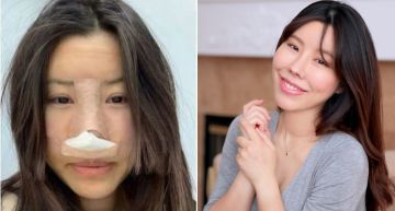 知名部落客花27萬「進廠維修」!跌倒摔成「豬鼻子」 網看心疼:太可憐了…