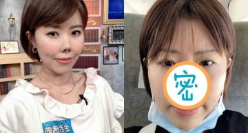 假鼻撞成豬鼻子!「金老佛爺」進廠維修成果曝光…「高挺鼻」仍有缺陷:半年後再動刀