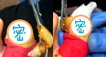 「發霉爛甲」不剪快長到腳底!醫判沒救...整片拔掉「驚見鮮紅絞肉」 3分鐘手術曝光!