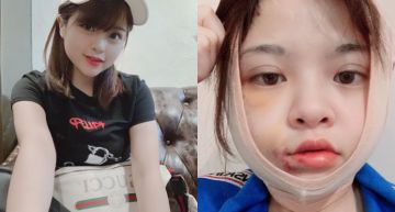 封印修圖軟體!整型醫師開掛「本壘板變小V」…米砂曬「術後近照」嗨爆:棒球賽季結束