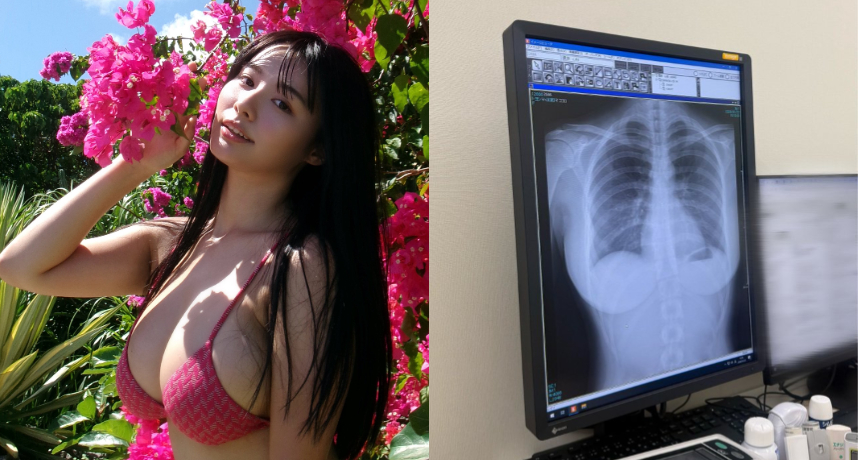 日本寫真偶像豐島心櫻曬X光照開心分享自己肺部很乾淨！「超完美胸型」意外引發熱議