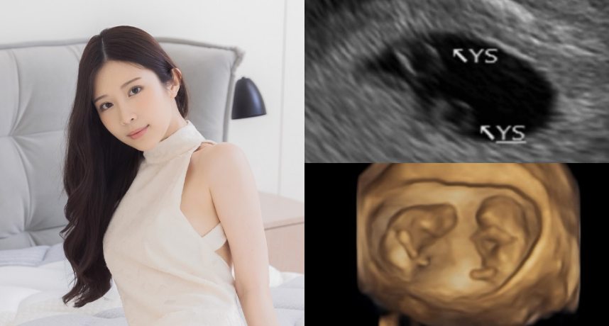 鄭家純驚喜宣布走過小產陰影「喜迎同卵雙胞胎」新生命加碼帶了手足引起全網祝福