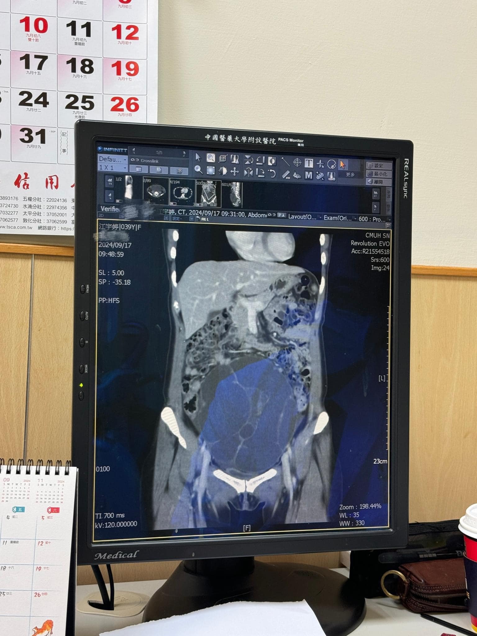 最嚴重恐拿掉整個子宮!鋼琴網紅「我是江老師」突曝下腹長19公分腫瘤