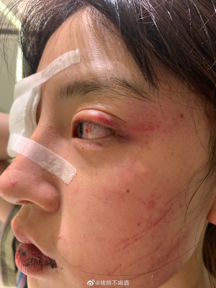 70萬人氣網美遭男友痛毆!眼睛縫針、嘴唇濺血 網怒酸渣男:快去坐牢!