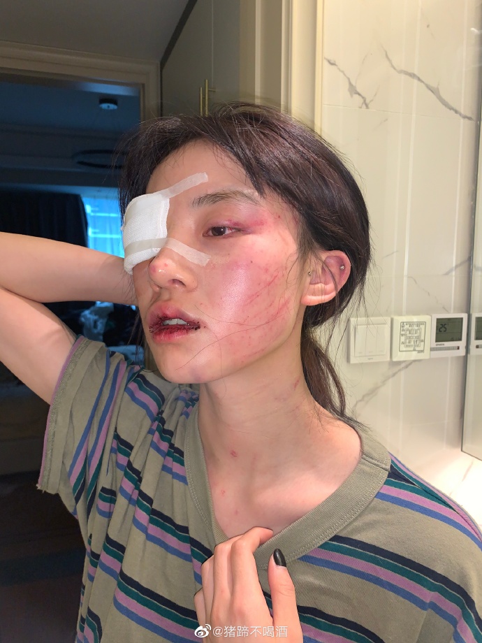 70萬人氣網美遭男友痛毆!眼睛縫針、嘴唇濺血 網怒酸渣男:快去坐牢!