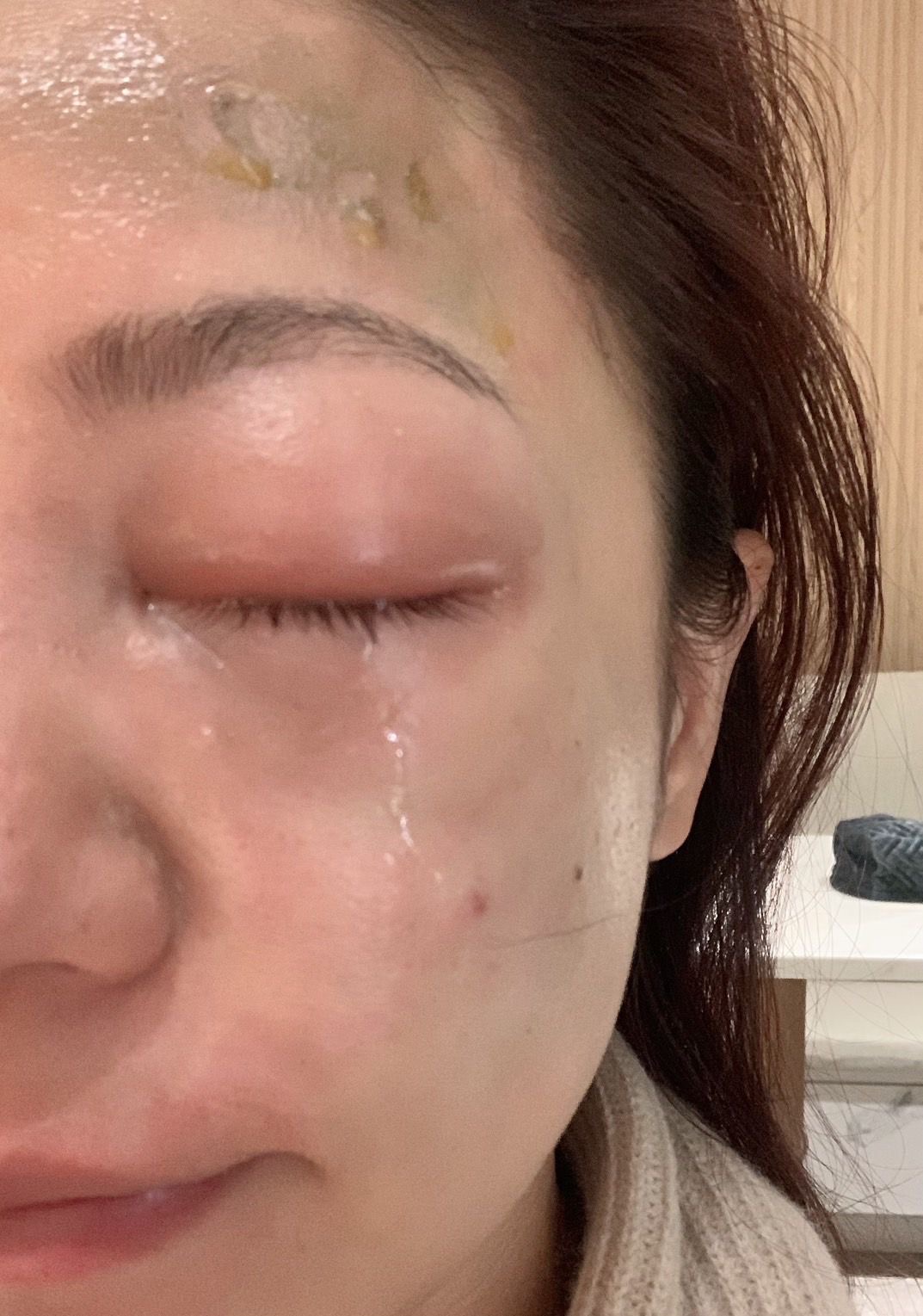 丁噹下廚釀意外!「半臉嚴重燙傷」左眼腫到睜不開 傷勢照曝光