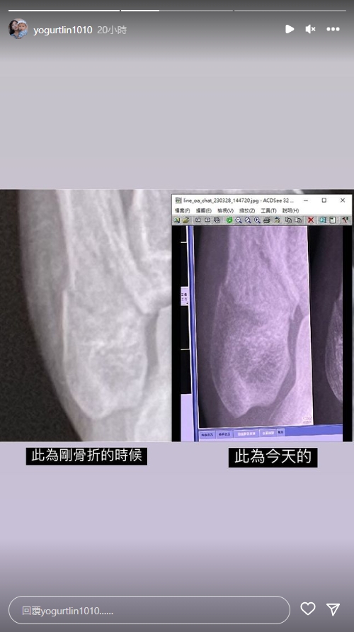 優格姐姐骨折2個月惡化！醫師診斷「開刀挖骨」嚇壞　曬X光照崩潰求助