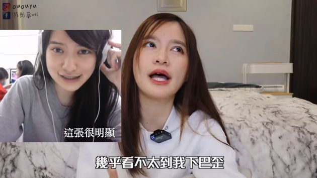後遺症!正顎手術後「下巴還是歪」 網紅淚勸:變美是有代價的