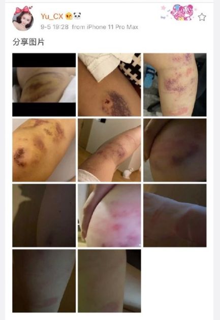 四肢全瘀青!女友再遭「死亡宣告」暴打 網氣炸:真的無恥