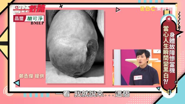 不敢出門!68歲婦「子宮整顆掉出來」夾大腿 醫曝驚悚原因