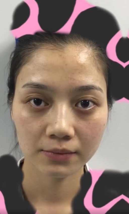 把自己整成迪麗熱巴！網紅曝光「整形前舊照」網全看傻