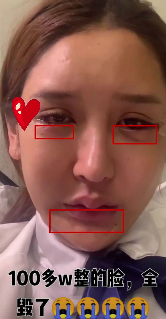  花300萬整成魚精！網紅爆「手術失敗」：整張臉凹成好多洞