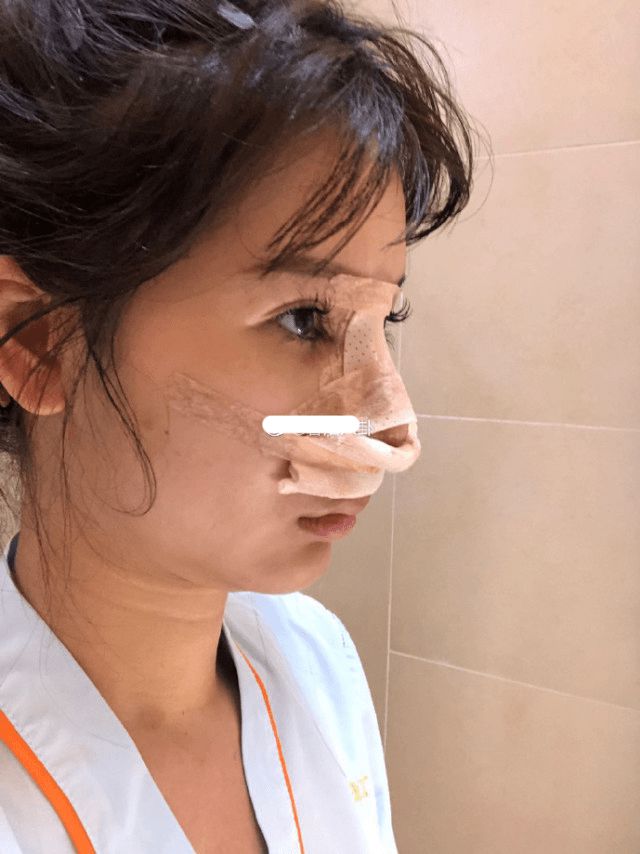 整很大！「暗黑版Angelababy」遭爆術後照　網嚇歪：大變活人