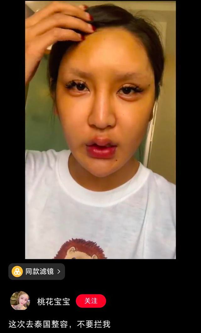  花300萬整成魚精！網紅爆「手術失敗」：整張臉凹成好多洞