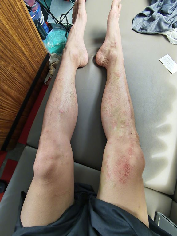 被水母螫成篩子!《小時代》陳學冬曬「滿腿傷照」:密集恐懼慎入