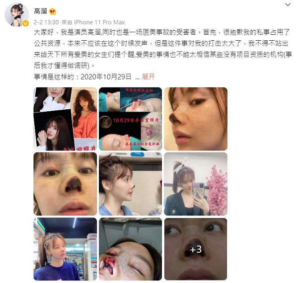 女星整形失敗「鼻頭全壞死」!驚悚照曝光 網全嚇歪!