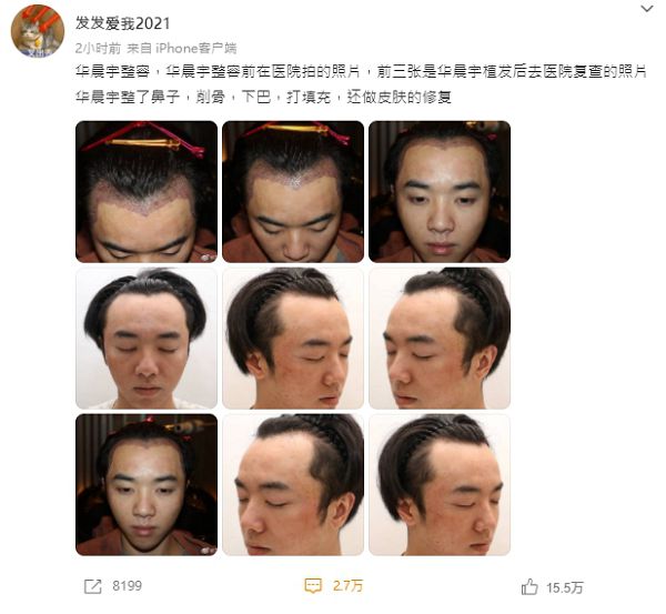 遭爆曾植髮、削骨！華晨宇「整形前」高清正臉照疑流出　網全看傻