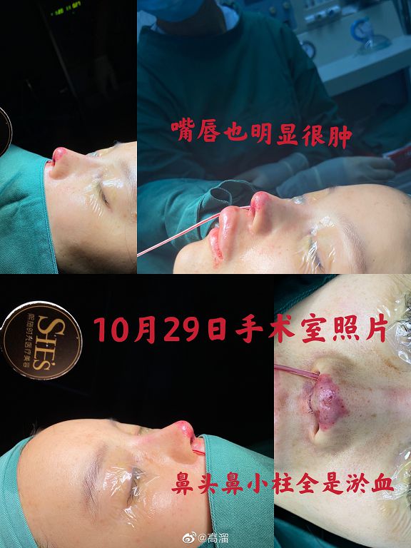 女星整形失敗「鼻頭全壞死」!驚悚照曝光 網全嚇歪!