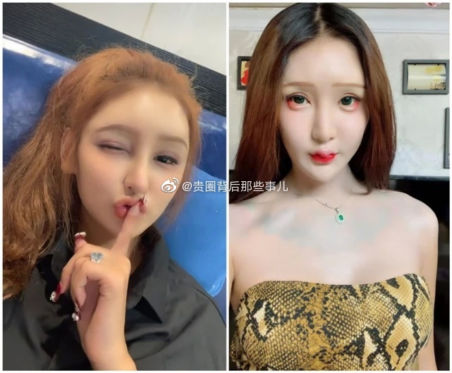 花300萬整成魚精!網紅爆「手術失敗」:整張臉凹成好多洞