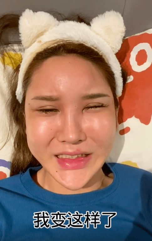 臉上打進400多支玻尿酸!網紅「整形失敗」崩潰:我變畸形了