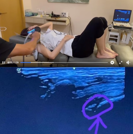 徐若瑄開唱前「右手肌腱撕裂」畫面曝光!就醫痛到狂哀叫:比生小孩還痛