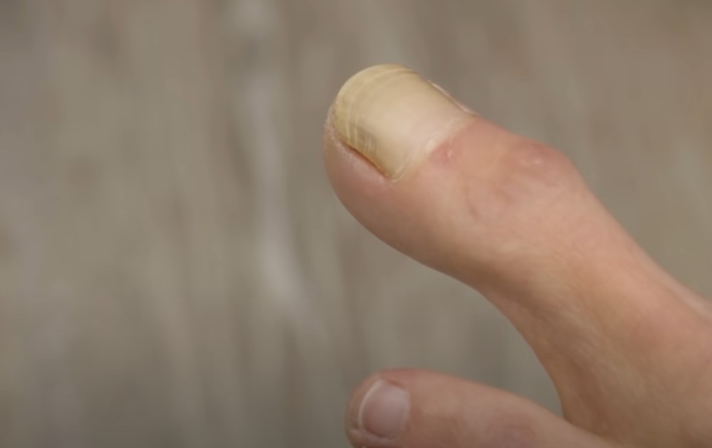 異於常人!美國節目曝「世紀大腳趾」 婦女一脫鞋醫師看傻:沒見過這麼粗的!