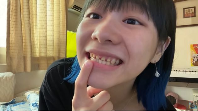 臉腫兩倍大!大胃王路路自爆「蜂窩性組織炎」:吃出抗藥性