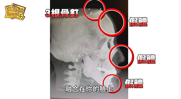 老娘我很會賺!雪碧砸400萬「路人→女神」 X光照曝「全是假體」