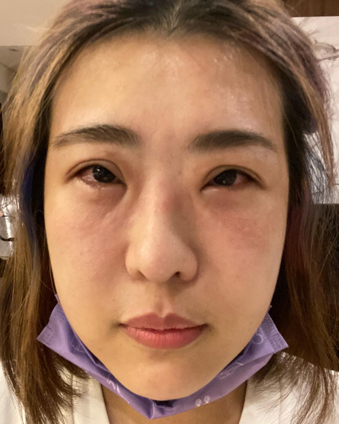 雙眼腫到變形!木星「半夜突發狀況」淚訴原因 網急壞:快掛急診!