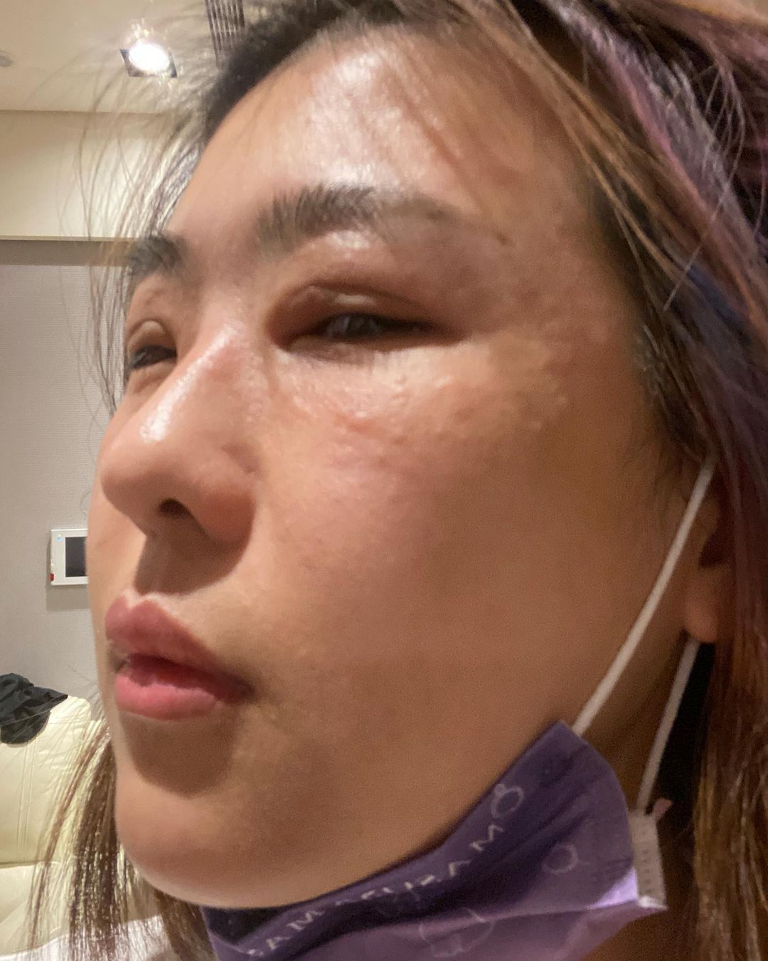 雙眼腫到變形!木星「半夜突發狀況」淚訴原因 網急壞:快掛急診!
