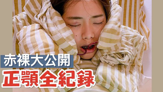 厚道掰掰!網紅「正顎手術」秒變臉 網驚:超像潤娥!