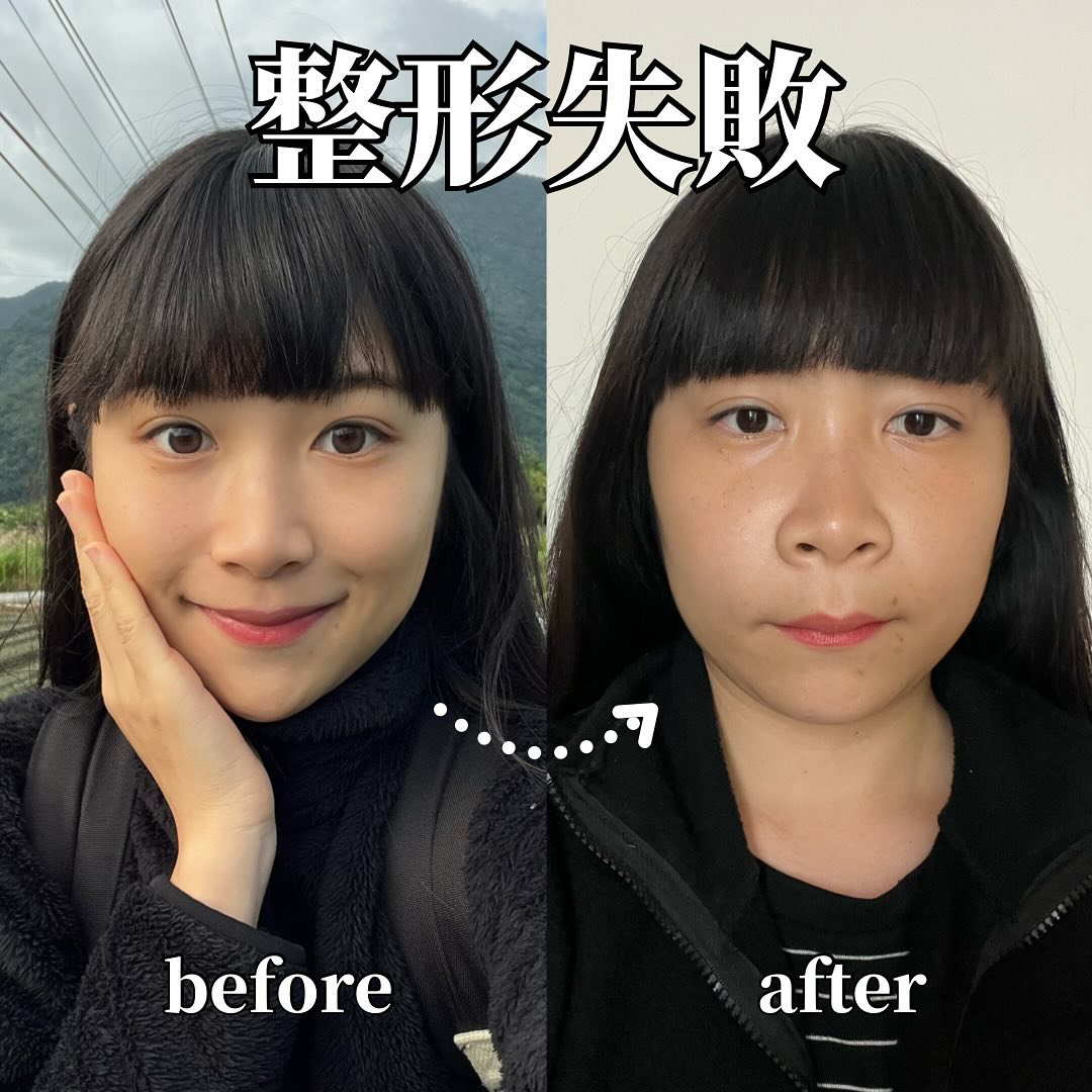 NanaQ驚爆整形失敗!親曬B/A照「下巴內縮慘變朝天鼻」她崩潰:不想照鏡子