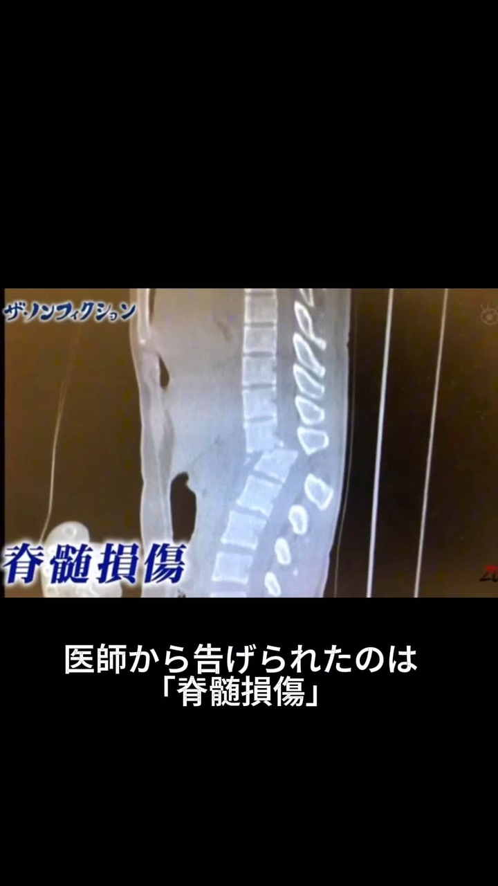 遭百公斤看板砸中!豬狩友香「下半身癱瘓」終身靠輪椅度日 悲吐:需靠管子如廁