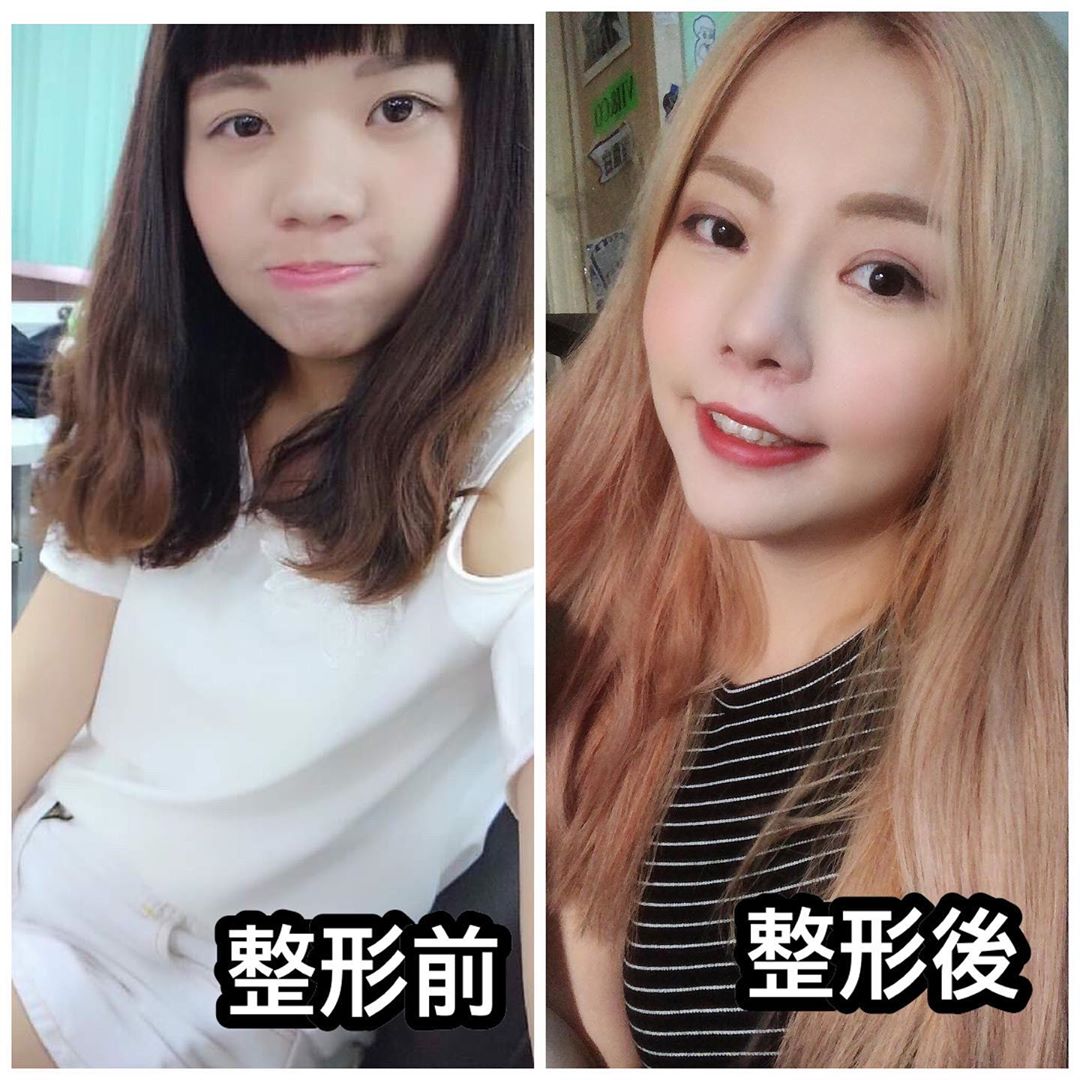 網紅 超直白 整形不到一年 再進廠 曝術後照 B E 全身傷口痛哭 被卡車壓過去 網紅 超直白 整形不到一年 再進廠 曝術後照 B E 全身傷口痛哭 被卡車壓過去