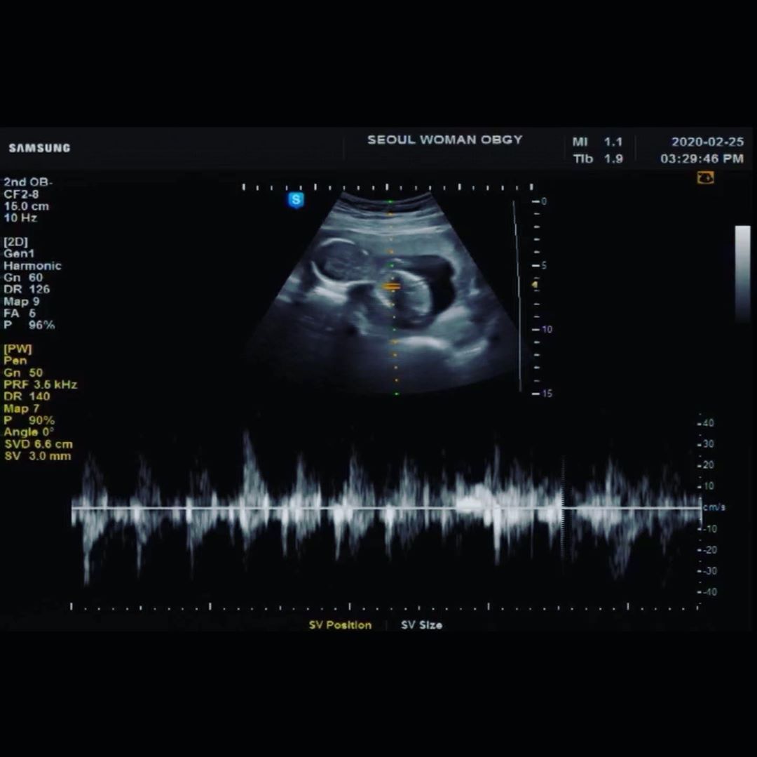 曾對妹妹許願「下輩子當我女兒吧」！具荷拉哥哥2月後曝意外喜訊　粉絲淚崩