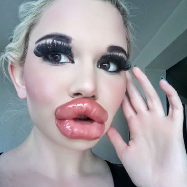 嘴唇動刀超過20次!網紅「狂打玻尿酸」:嘴巴就半張臉了