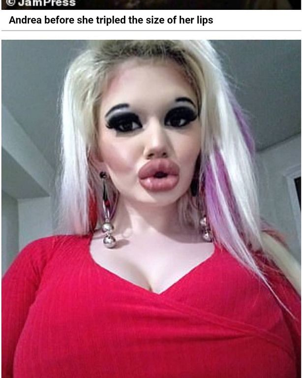 嘴唇動刀超過20次!網紅「狂打玻尿酸」:嘴巴就半張臉了