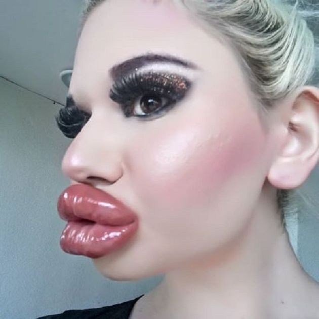 嘴唇動刀超過20次!網紅「狂打玻尿酸」:嘴巴就半張臉了