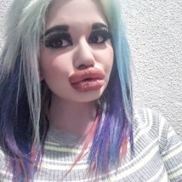 嘴唇動刀超過20次!網紅「狂打玻尿酸」:嘴巴就半張臉了