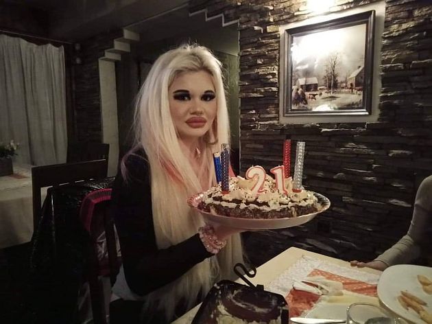 嘴唇動刀超過20次!網紅「狂打玻尿酸」:嘴巴就半張臉了