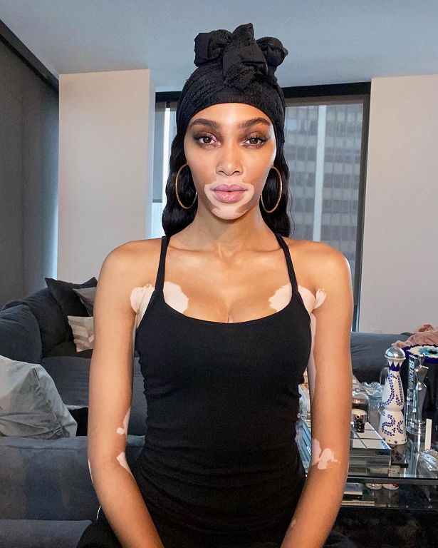 NBA知名球星爆熱戀「白斑症女模」!牽手照曝光:交往一星期了