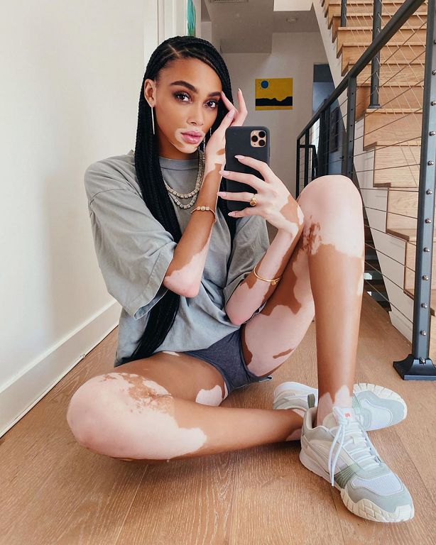 NBA知名球星爆熱戀「白斑症女模」!牽手照曝光:交往一星期了