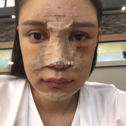 14歲就進廠！超兇網紅「16年整形100次」　「術後照曝光」嚇歪網！