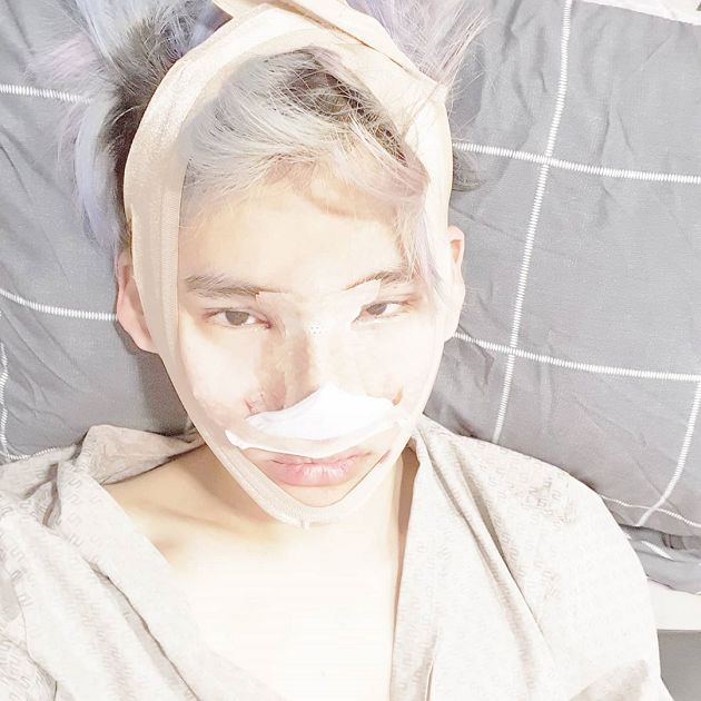 整形過程全公開！韓知名饒舌歌手「腫成豬頭」樣子曝光：變身花美男