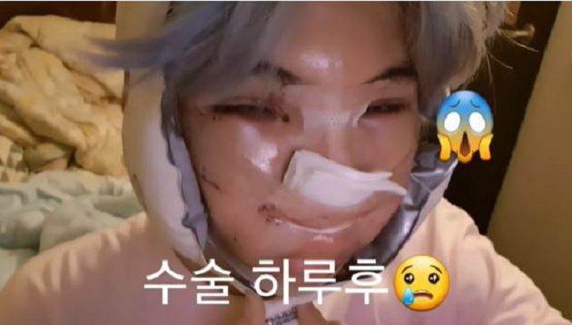 整形過程全公開！韓知名饒舌歌手「腫成豬頭」樣子曝光：變身花美男