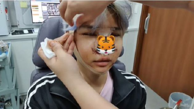 整形過程全公開！韓知名饒舌歌手「腫成豬頭」樣子曝光：變身花美男